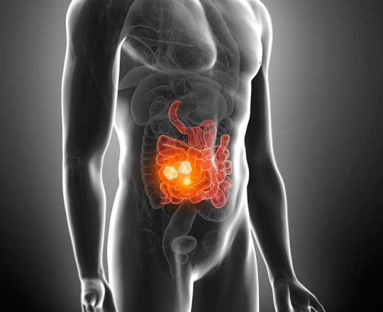 Câncer Colorretal: Crescimento anormal das células do intestino