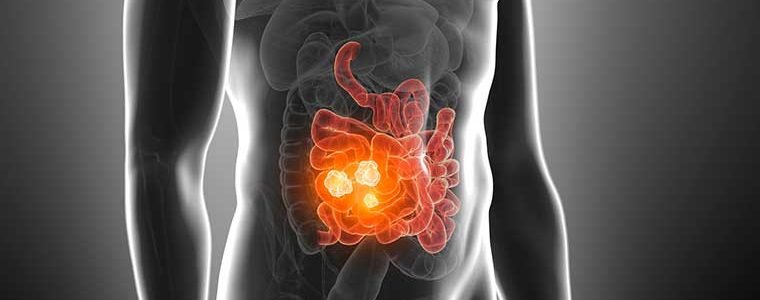 Câncer Colorretal: Crescimento anormal das células do intestino