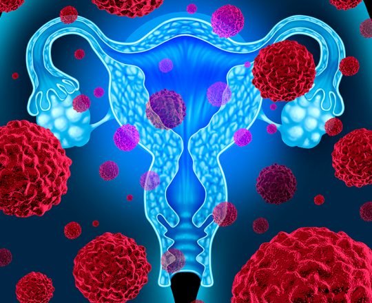 Câncer de ovário é o tumor ginecológico de menor chance de cura