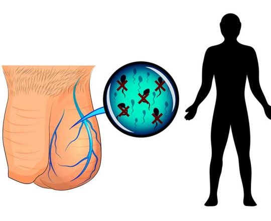 Varicocele: Causa tratável mais comum de infertilidade masculina