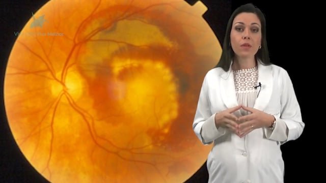 Como é feito o diagnóstico da degeneração macular relacionada à idade?