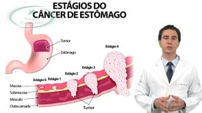 Existe cura para o câncer de estômago?