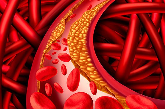 O que é a dislipidemia?